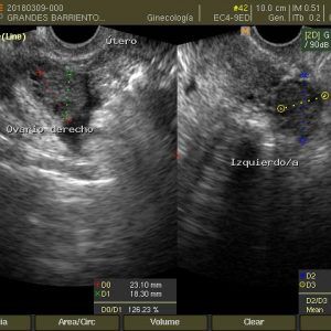 ecografia-transvaginal
